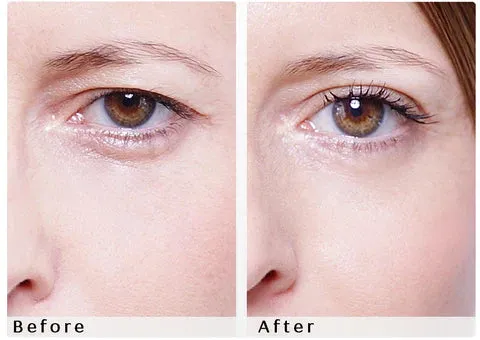 Beauty Eyelift - Medium | Wonderstripes
